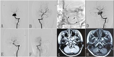 Application of the Pipeline Embolization Device for Giant Vertebrobasilar Dissecting Aneurysms in Pediatric Patients